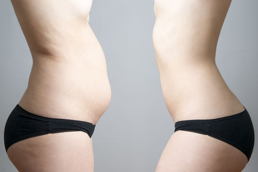 Liposuction and Body Contouring