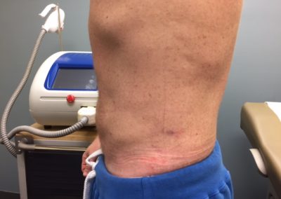 LIPO3AFTER