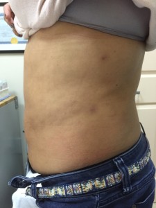 Lipo After