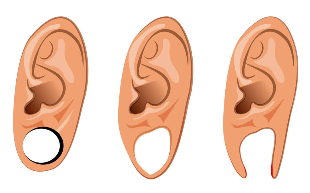 Ear Lobe Repair Edgewater NJ