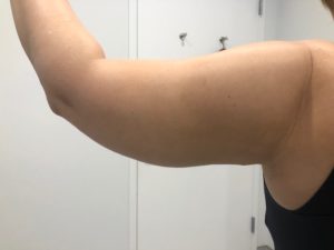 left Arm lipo after