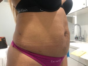Lipo stomach before