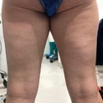 Lipo thighs before