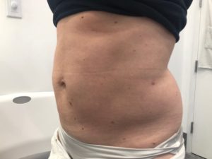After Vaser Lipo Midsection
